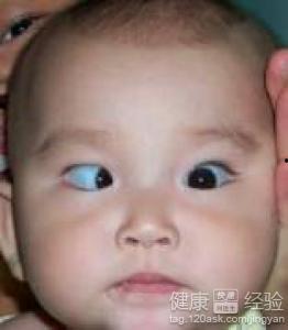 成人斜眼外观矫正视频,视频揭秘成人外观改善之旅